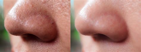 large pores on either side of nose